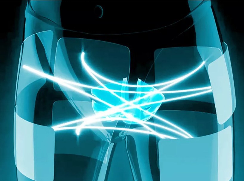 EPOsme03